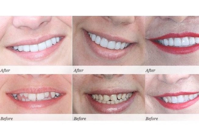 Smile Like You Paid for It! The Cost of Teeth Whitening